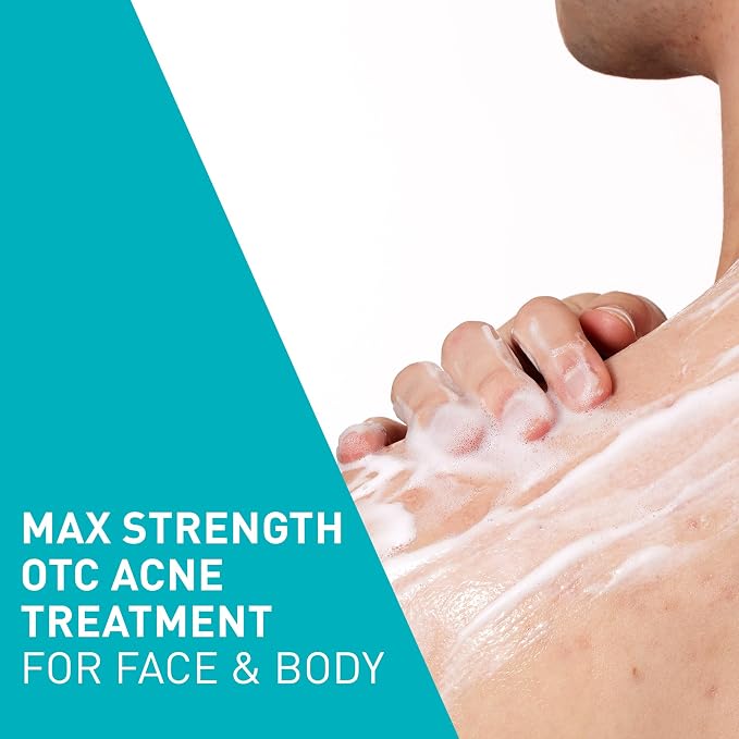 Person applying foamy acne treatment to face and body with text 'Max Strength OTC Acne Treatment for Face & Body' on a teal and white background.