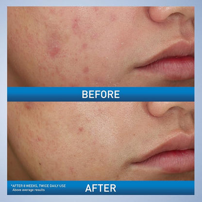 Before and after comparison of skin treatment showing improvement on a person's face.