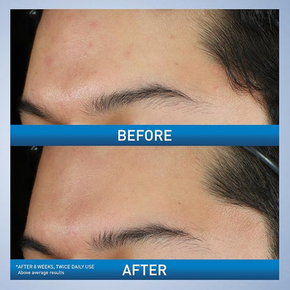 Before and after comparison of a person's skin on the forehead with a blue bar indicating results.